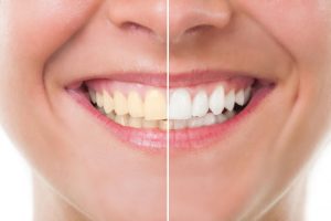 Centre Odontològic Sant Boi tratamiento blanqueamiento dental