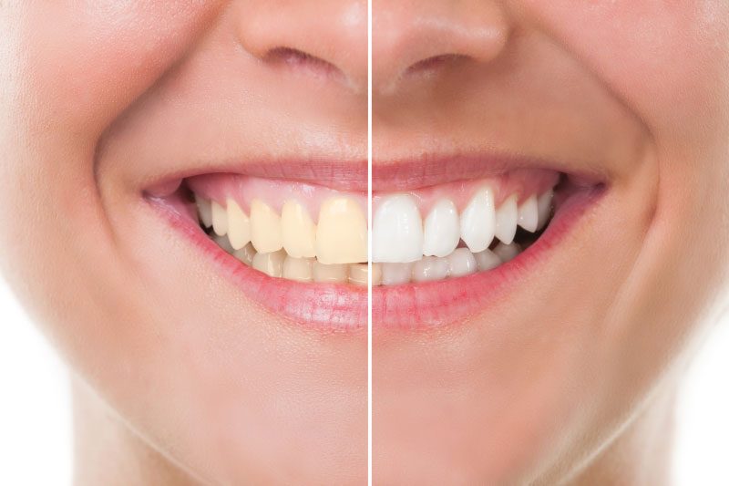 Centre Odontològic Sant Boi tratamiento blanqueamiento dental