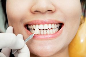 Centre Odontològic Sant Boi tratamiento estética dental