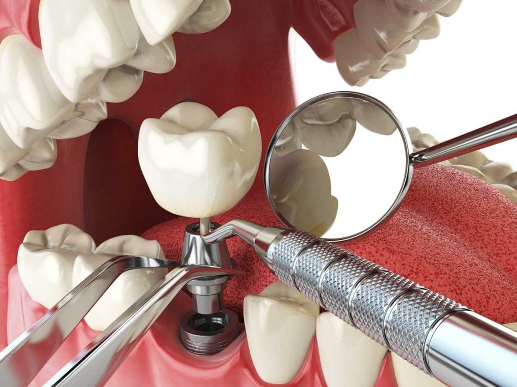 Centre odontòlogic Sant Boi implantes dentales