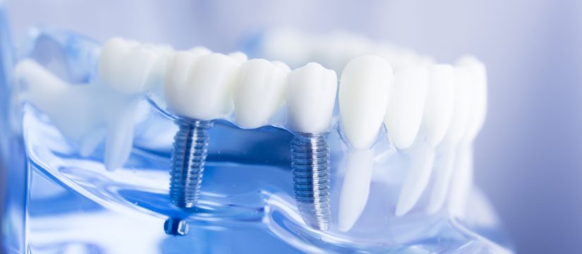 Periimplantitis en Sant Boi