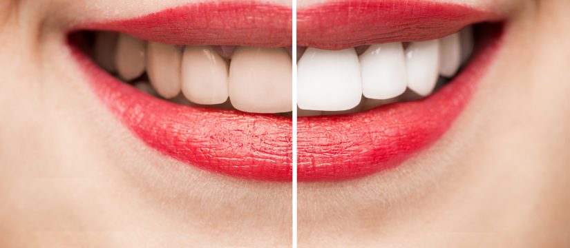 Blanqueamiento dental en Sant Boi